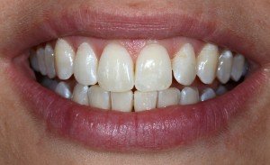 witte-vlekken 5